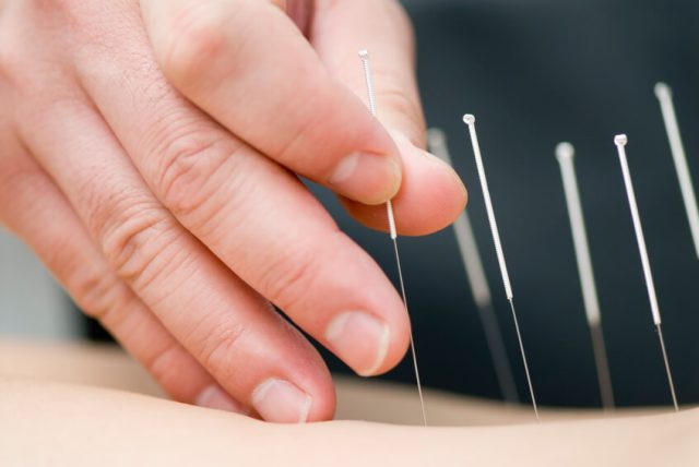 Treatment-by-acupuncture-000004479493_Small-1