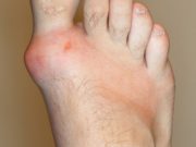 Understanding Gout and How to Prevent it Naturally