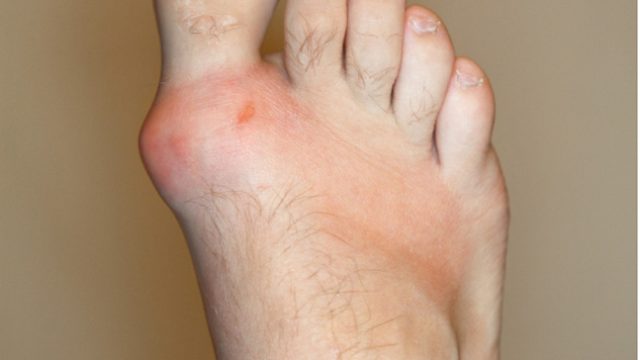 gout_foot3